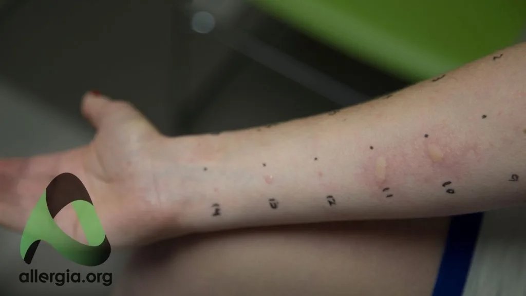 Пример результатов прик-теста — кожная реакция на аллергены