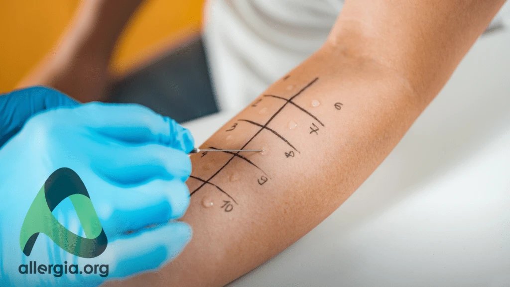 Прик-тест — кожная проба для диагностики аллергии