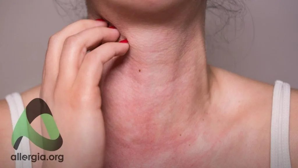 Аллергия и психосоматика — влияние стресса на аллергические реакции