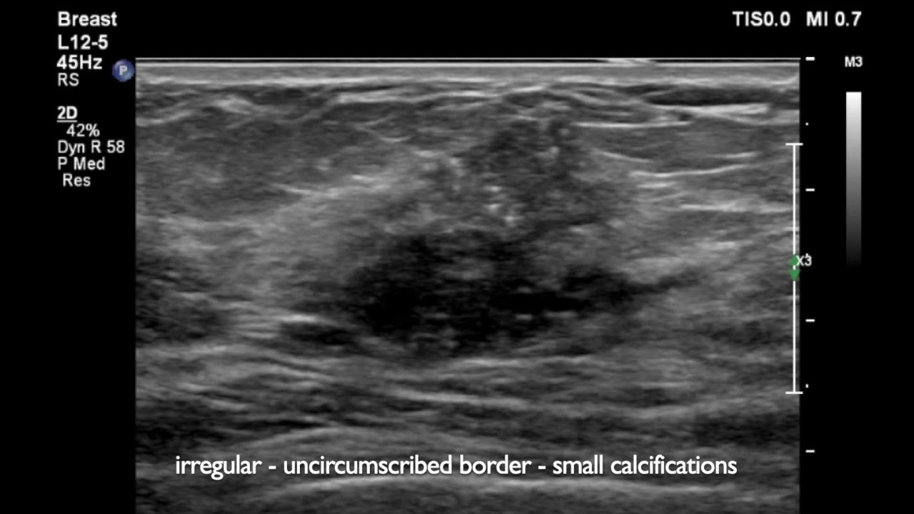 УЗИ молочной железы